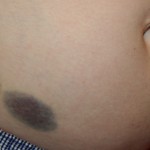 bruises on bump